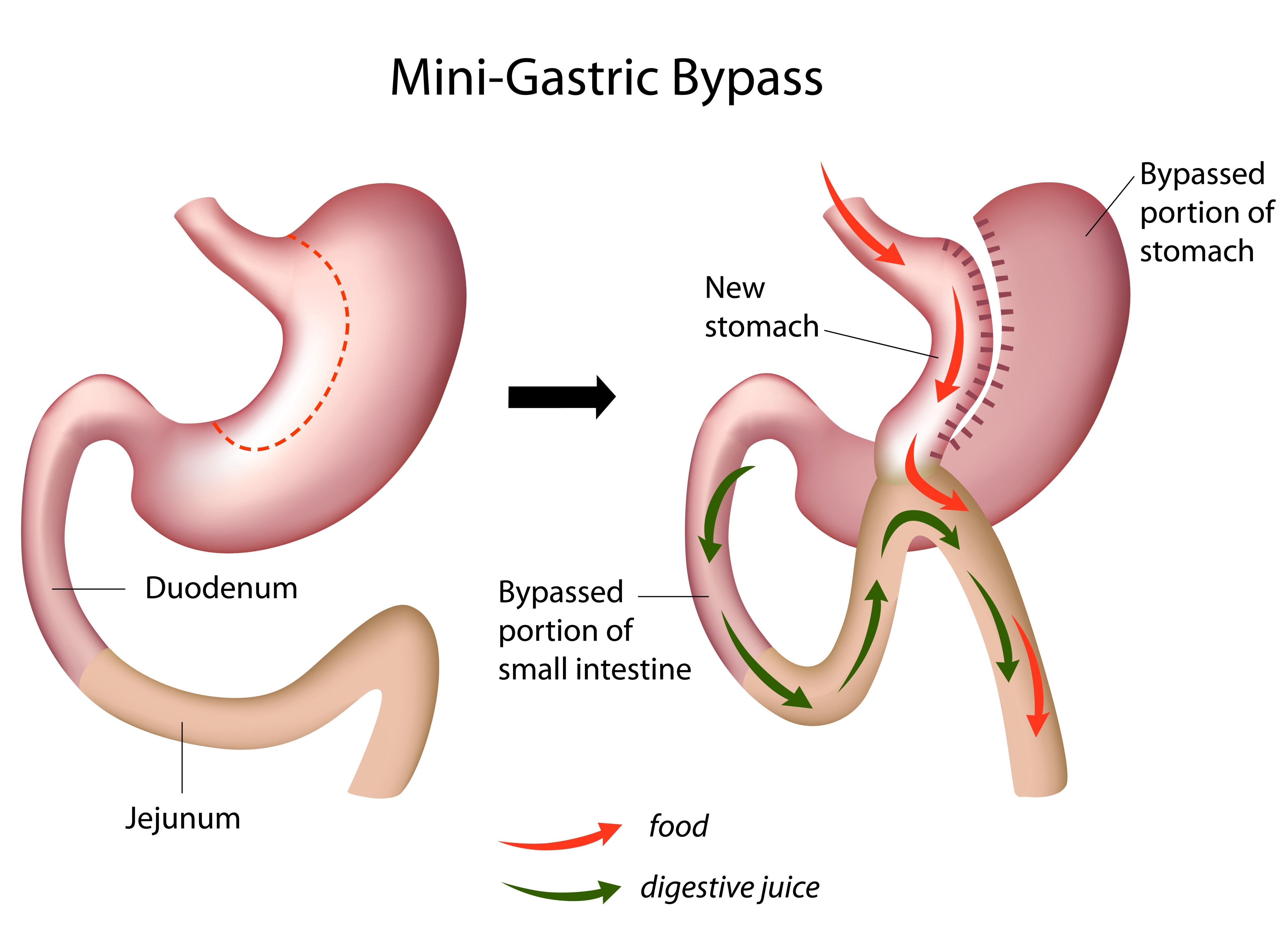 MINI GASTRIC BYPASS